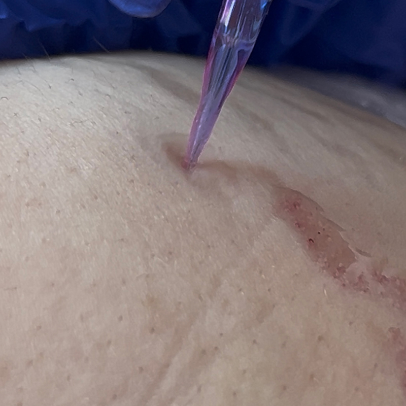 SKINSCULPT MICRONEEDLING THERAPY Suero para microneedling Stretch Marks Formula 30 ml