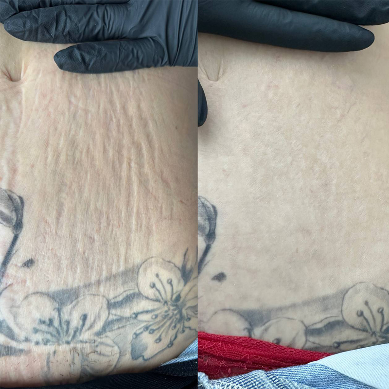 SKINSCULPT MICRONEEDLING THERAPY Suero para microneedling Stretch Marks Formula 30 ml