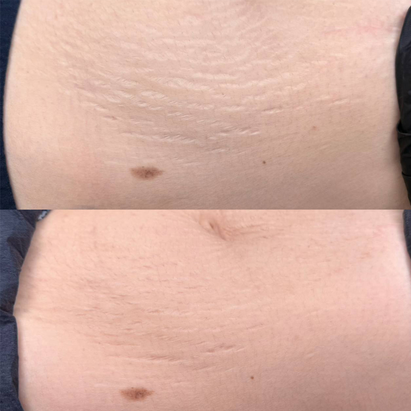 SKINSCULPT MICRONEEDLING THERAPY Suero para microneedling Stretch Marks Formula 30 ml