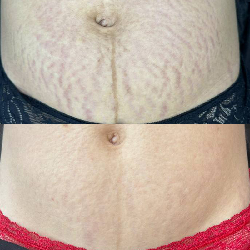 SKINSCULPT MICRONEEDLING THERAPY Suero para microneedling Stretch Marks Formula 30 ml