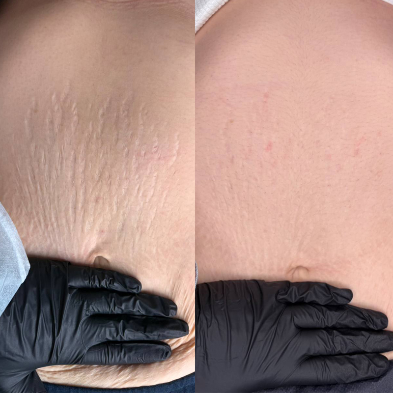 SKINSCULPT MICRONEEDLING THERAPY Suero para microneedling Stretch Marks Formula 30 ml